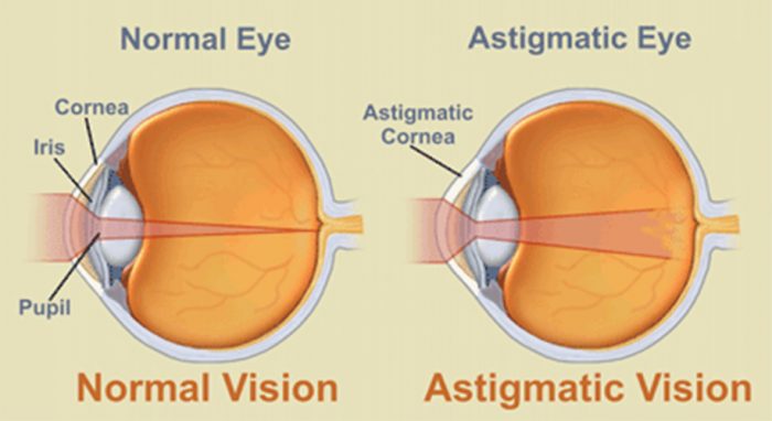 Astigmatism Axis Chart