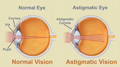 What Does AXIS Mean for Glasses Prescription? 19 Normal eyes vs astigmatic eye
