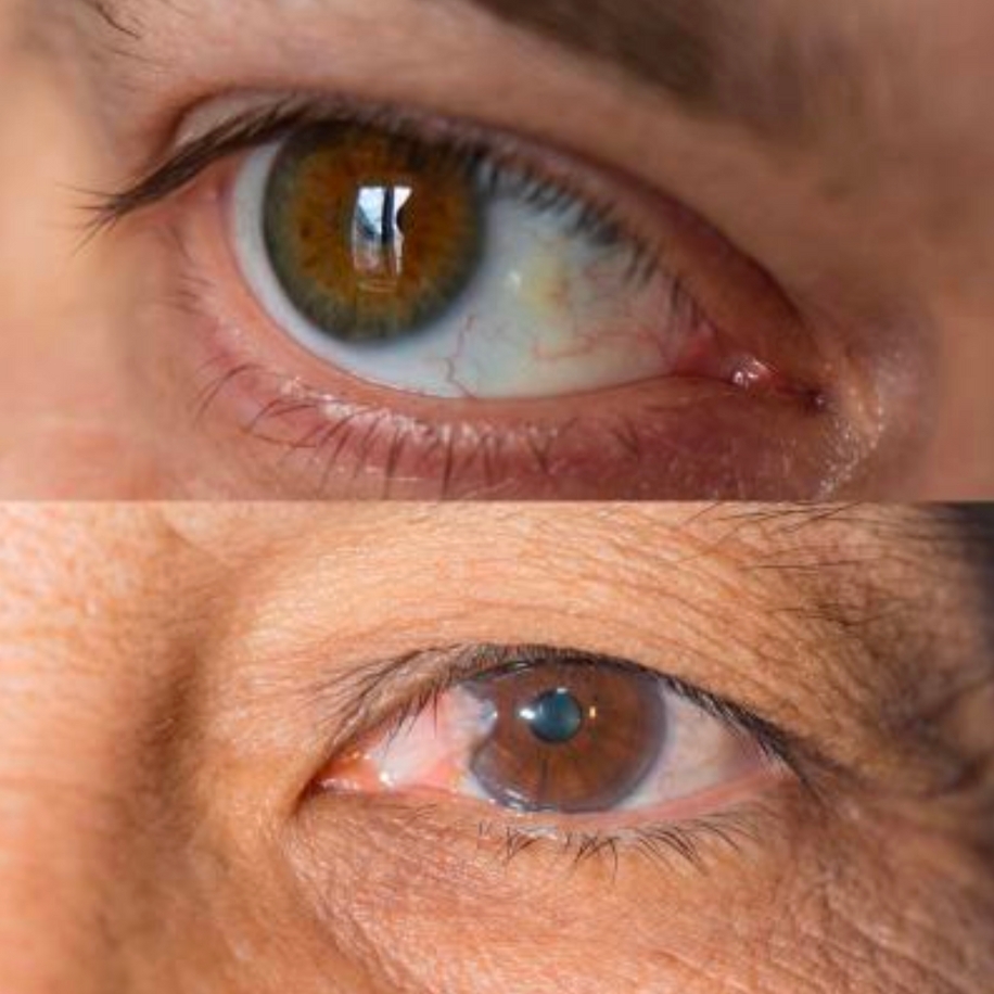 Close-up of two human eyes showcasing different ages, with one eye having noticeable redness.