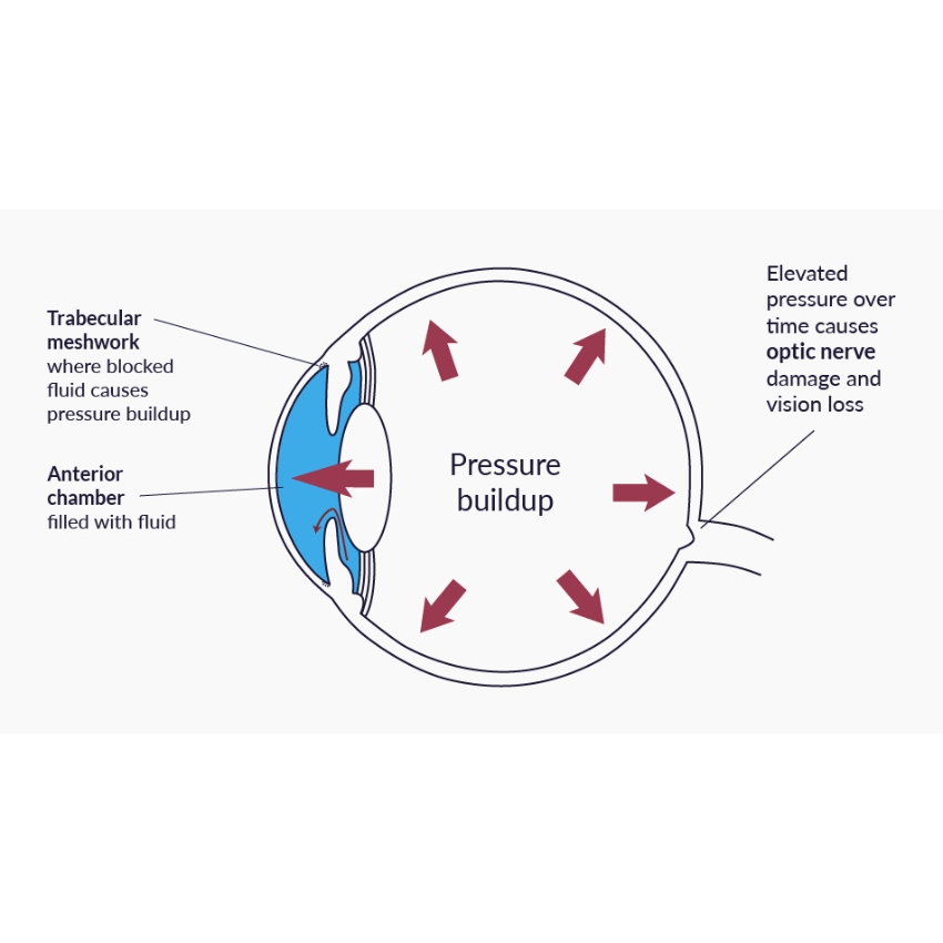 Exploring Eye Pressure and the Eye Puff Test