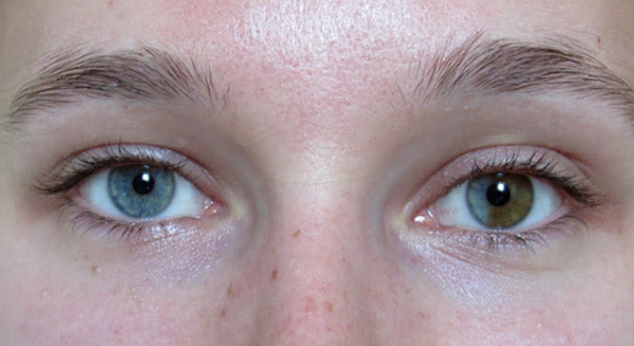 Close-up of two heterochromatic eyes; the left eye is blue, and the right eye is hazel.